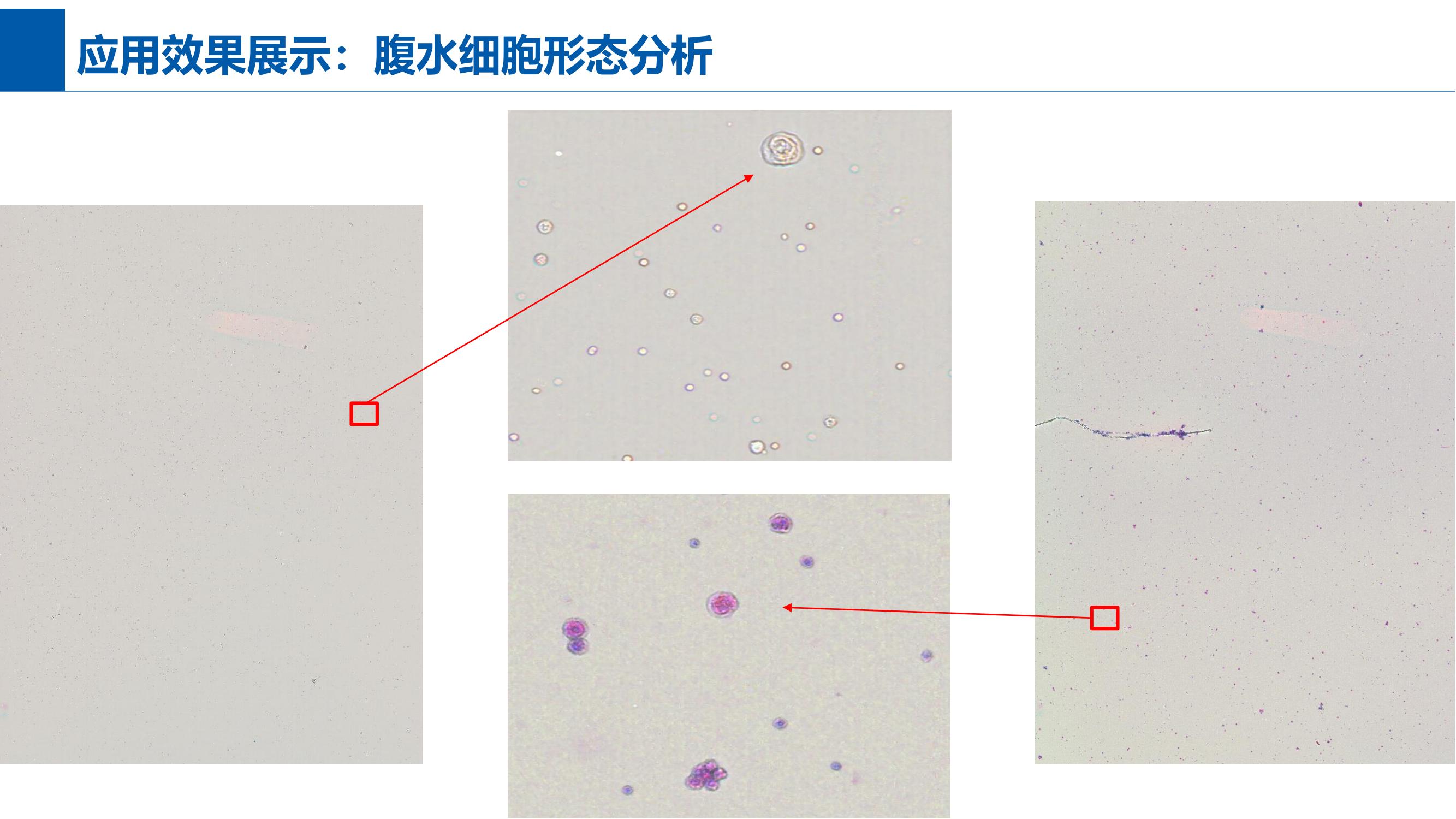 腹水细胞形态分析效果
