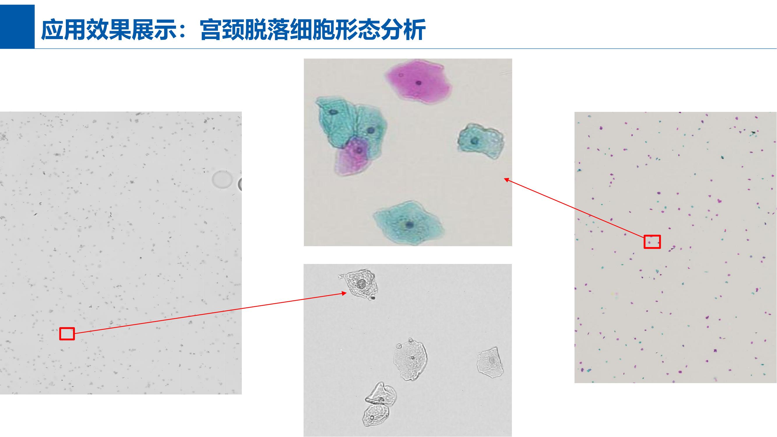 宫颈脱落细胞形态分析效果